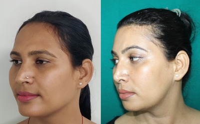 facial feminization surgery